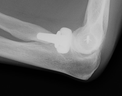 Radial Head Replacement Lysis Lateral